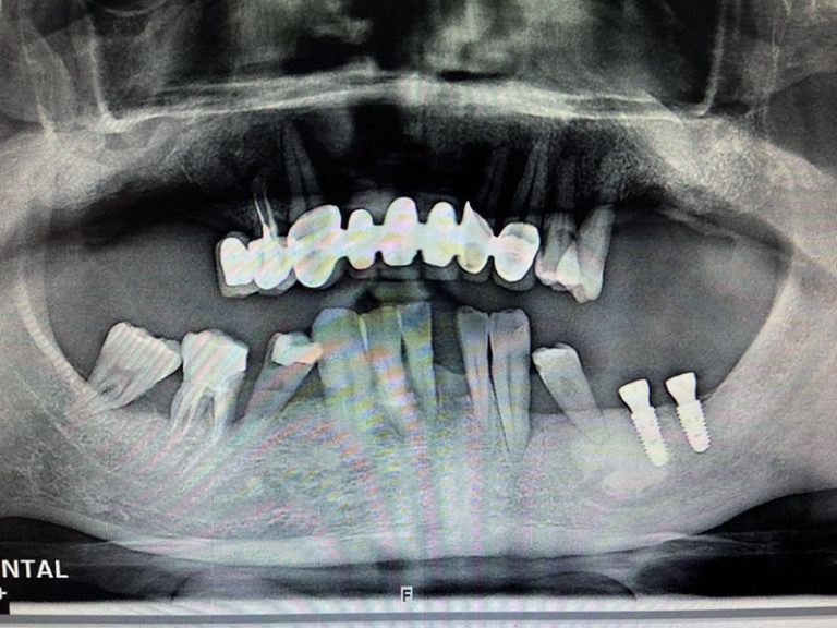 植牙案例宋子濃-2