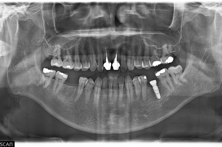 case-implant-92-2
