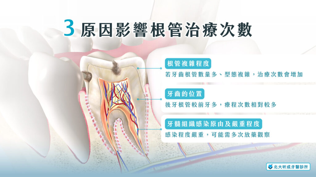 影響根管治療次數的原因-北大昕成